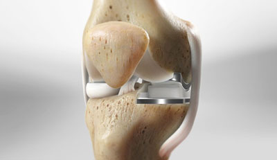Minimally Invasive