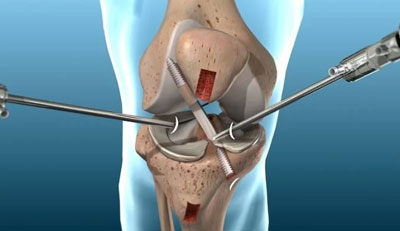 Arthroscopy