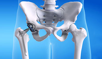Hip Replacement