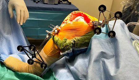 Robotic TKR